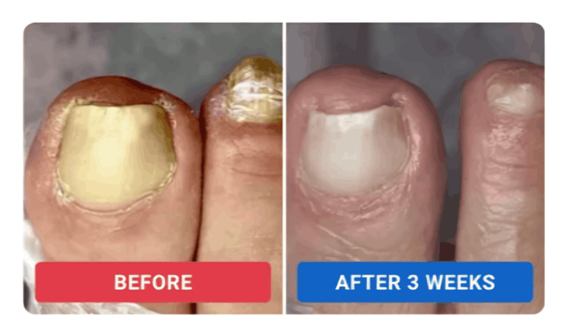 Orivello Nail Fungus Pen review by Elena S. – Orivello