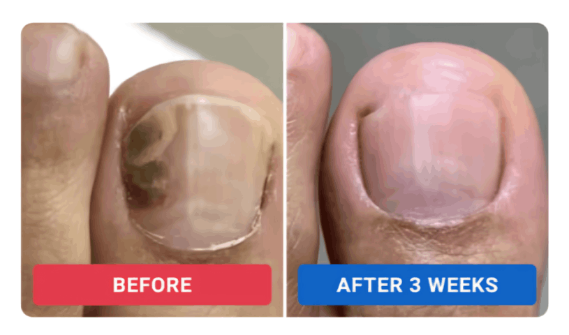 Orivello Nail Fungus Pen review by Rachel M. – Orivello