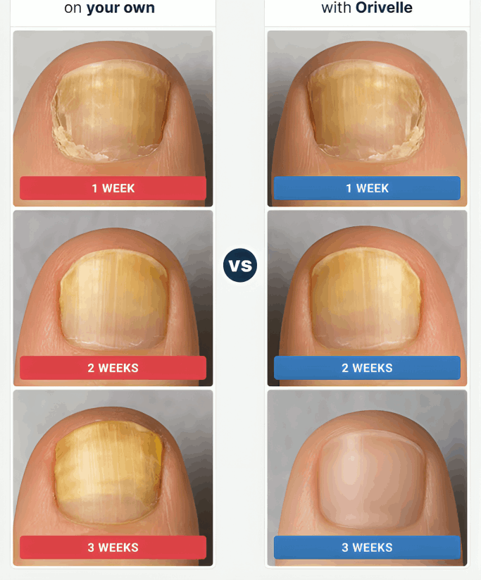 Orivello Nail Fungus Pen before and after – Orivello